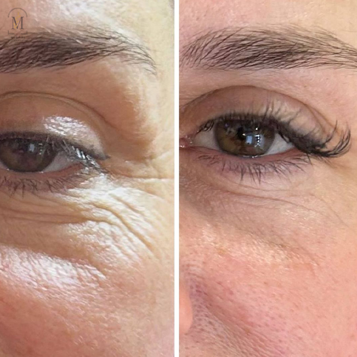 Photofacial laser treatment for skin brightening