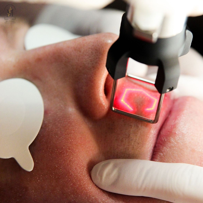 CO2 fractional laser treatment for acne scars
