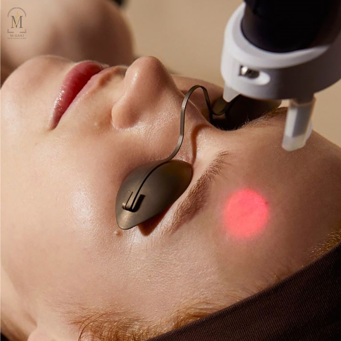 Laser Toning for Face