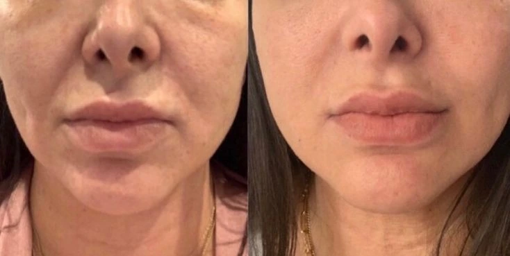 HIFU Skin Tightening Treatment