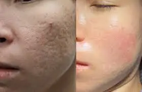 Acne Scar Treatment