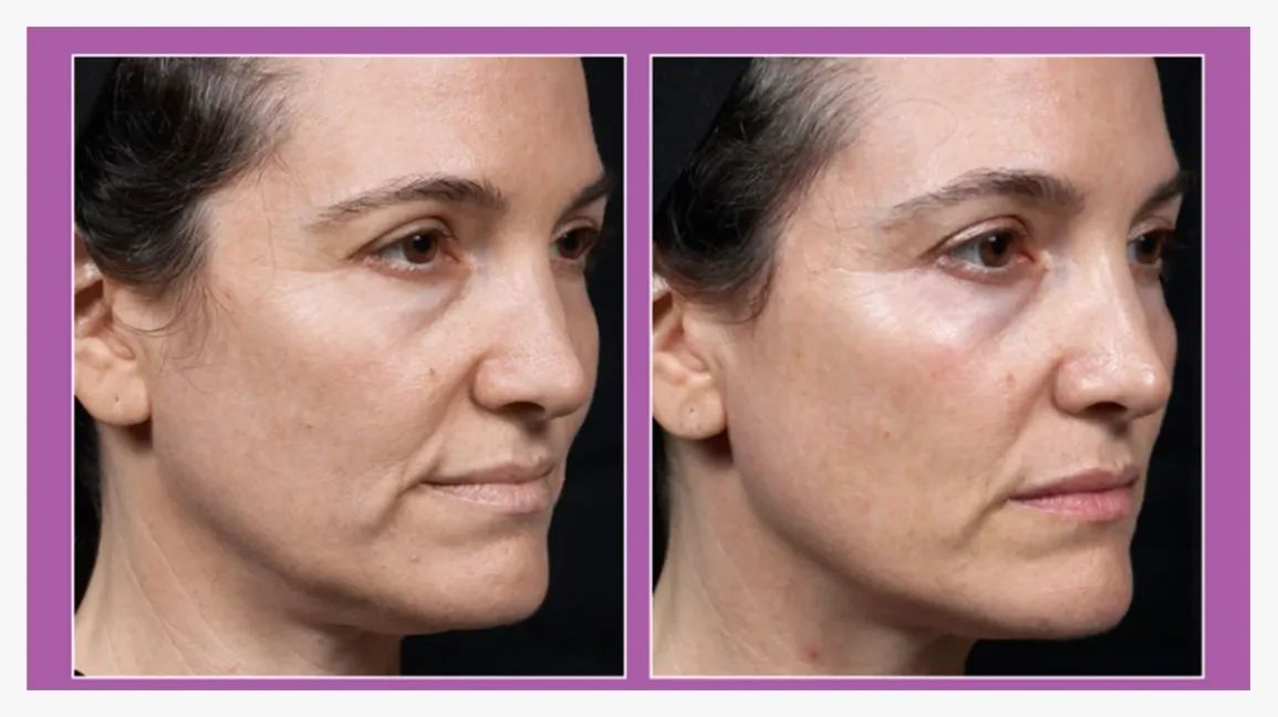 Radio Frequency Skin Tightening