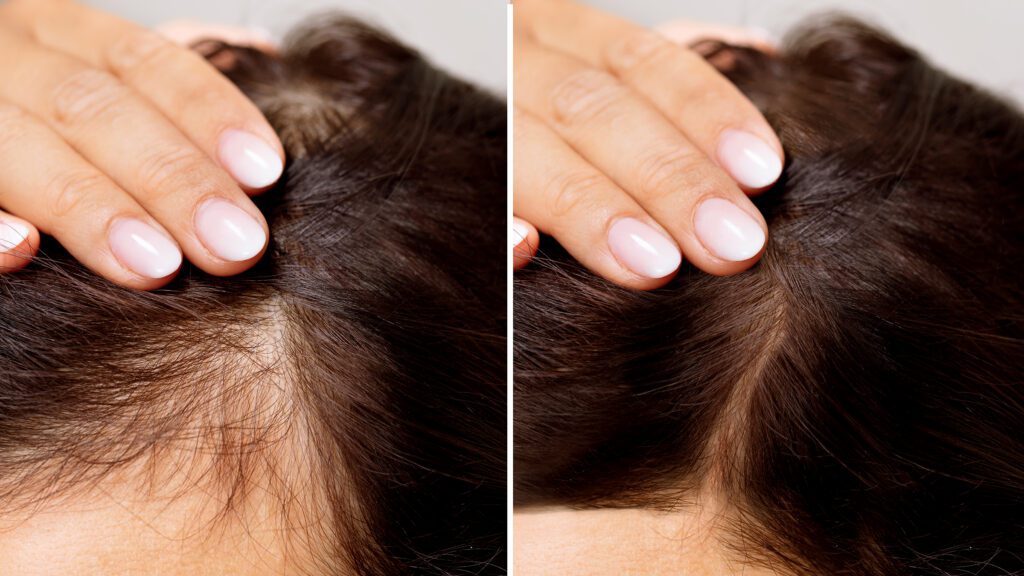 PRP Hair Treatment