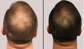 PRP Hair Treatment natural solution for hair fall