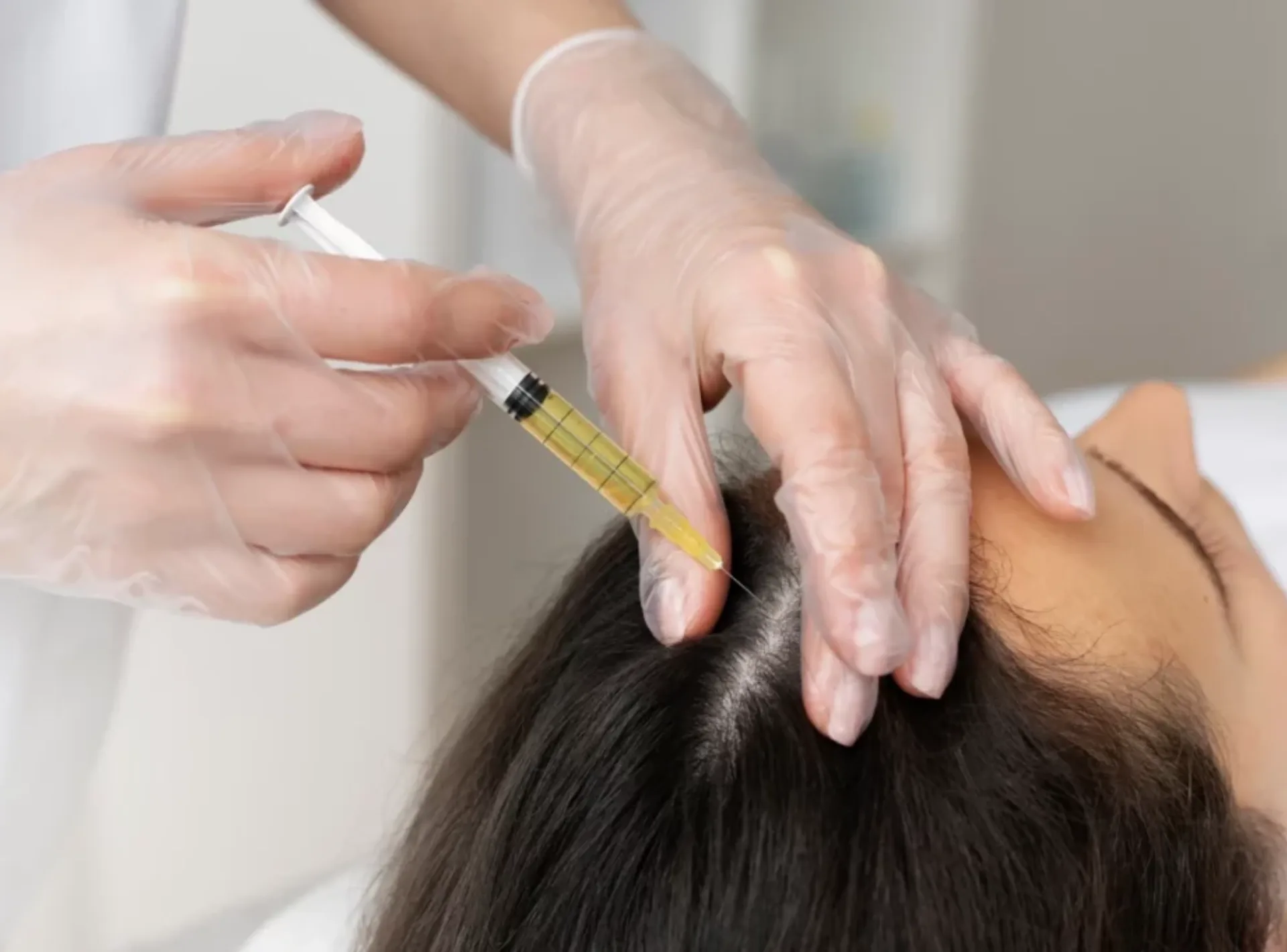 PRP Hair Treatment for hair growth
