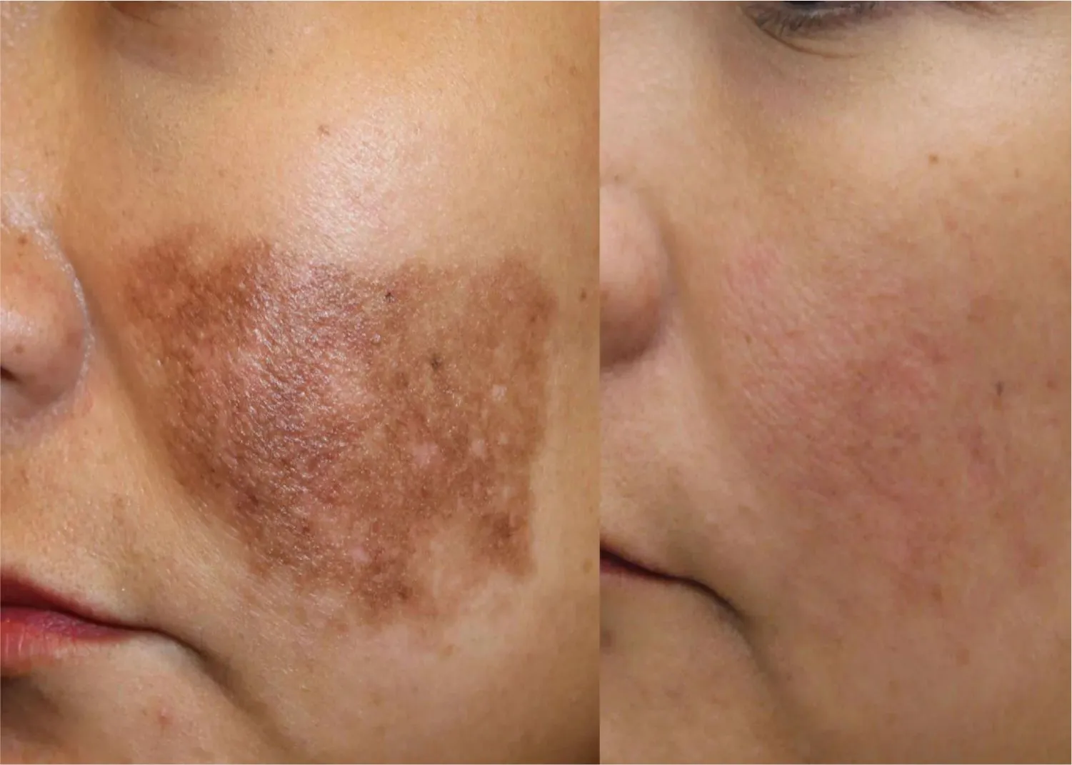 Pigmentation Treatment in Rohini