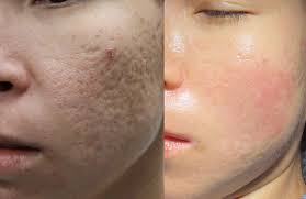 Acne Scar Treatment in Rohini