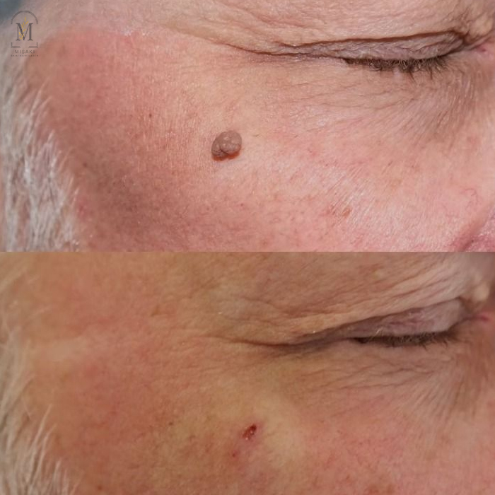 Wart Removal Treatment