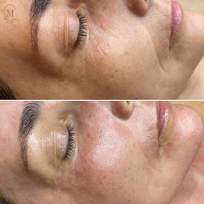 Advanced Microneedling