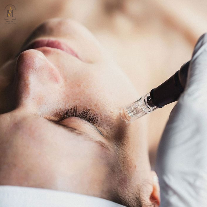 Exomoses Skin Treatment