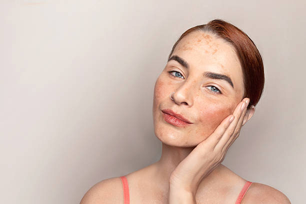 Pigmentation Treatment for Dark Spots & Melasma