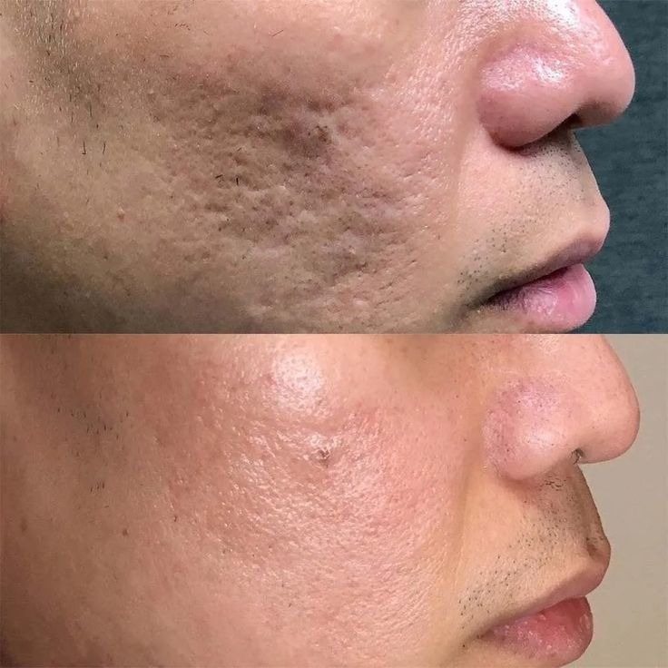 Acne Treatment Near Me