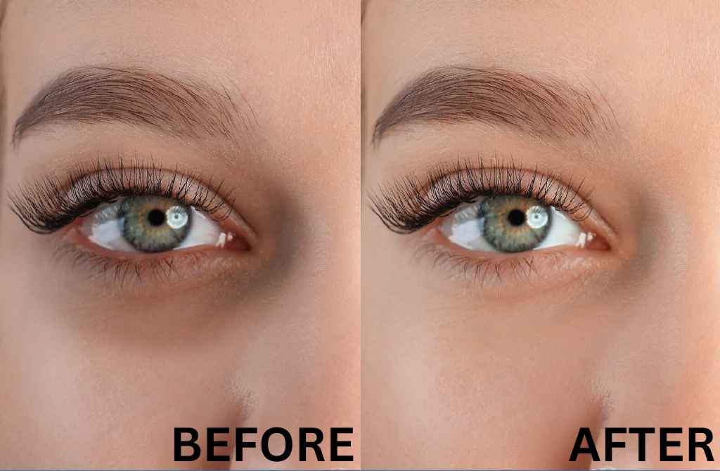Dark Circles Under Eye Treatment