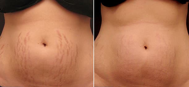 Stretch Marks Removal Treatment