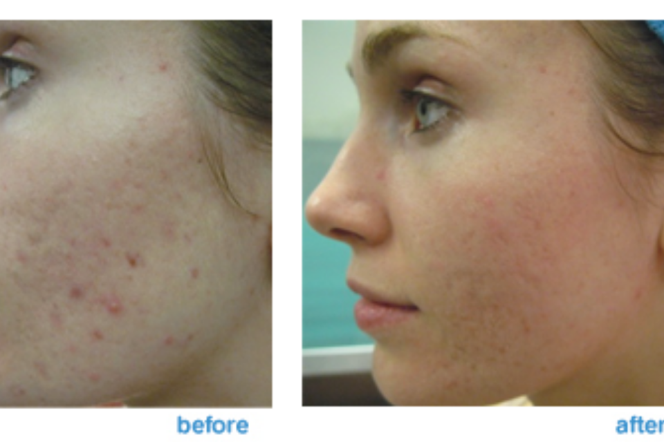 CO2 fractional laser treatment for acne scars
