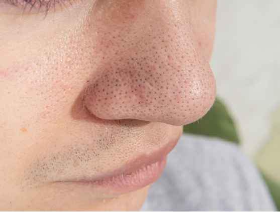 Open Pores Treatment in Rohini