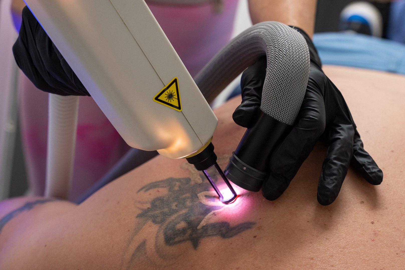 Laser Tattoo Removal in Rohini