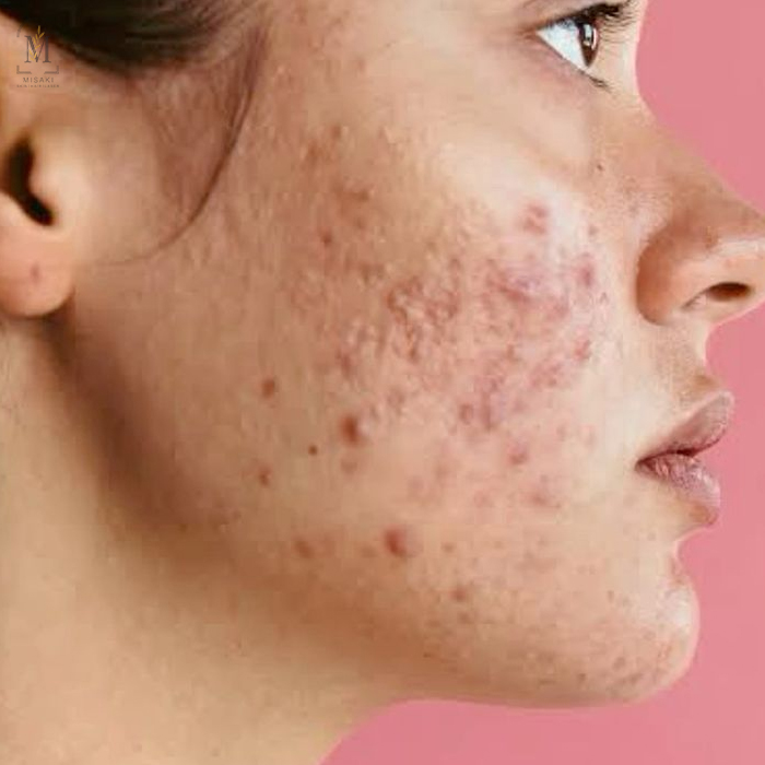 Best Acne Treatment in Rohini