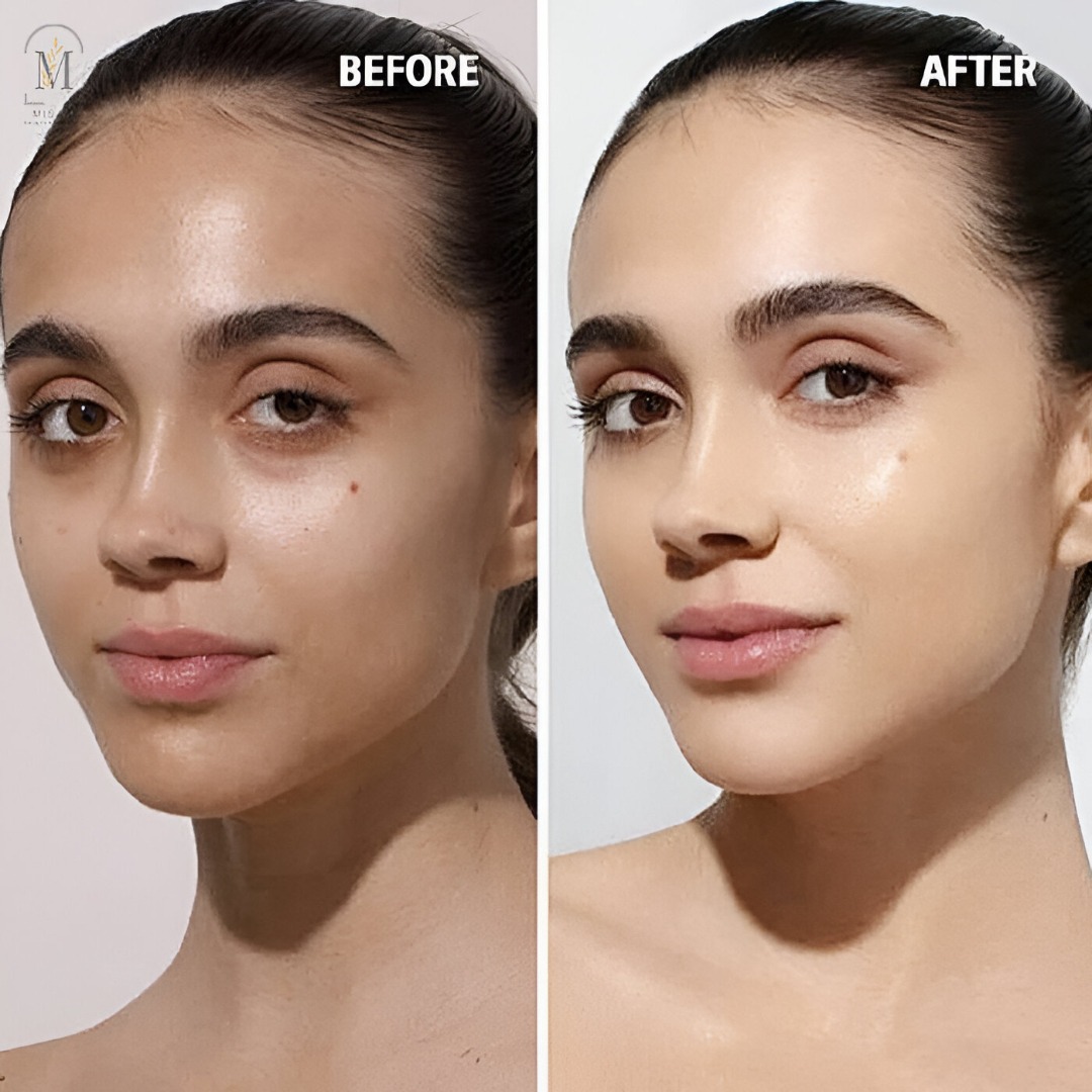 Pigmentation Treatment