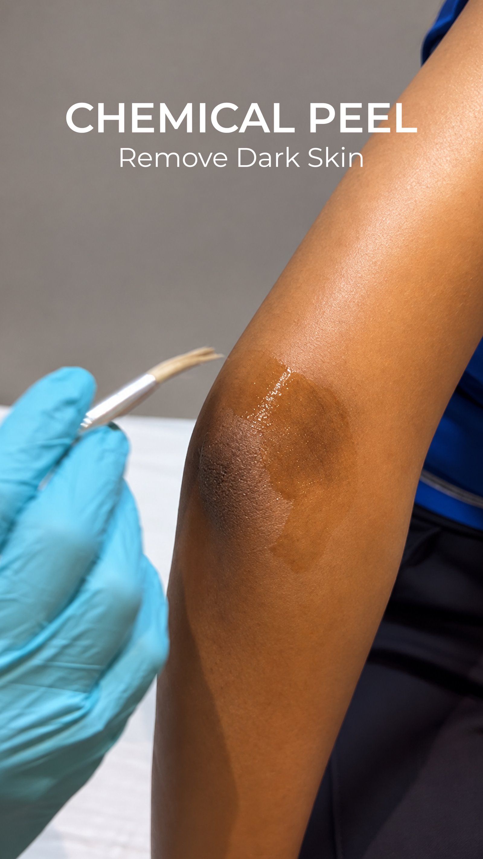 Chemical Peel Treatment