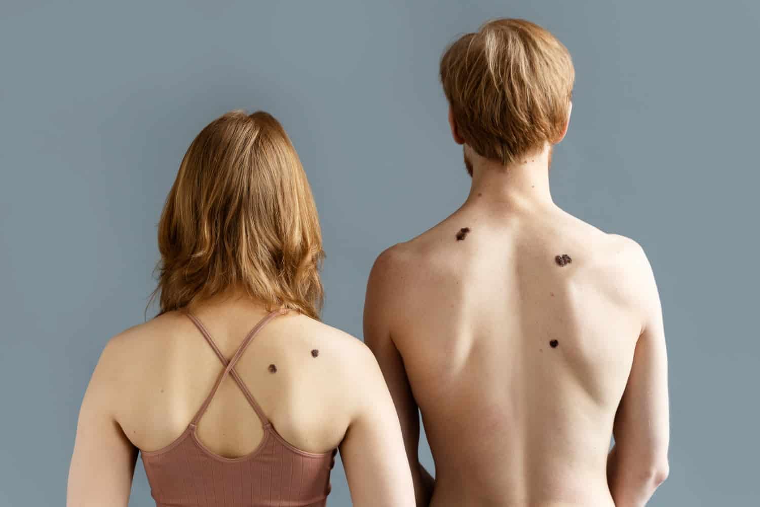 back-view-young-people-with-moles