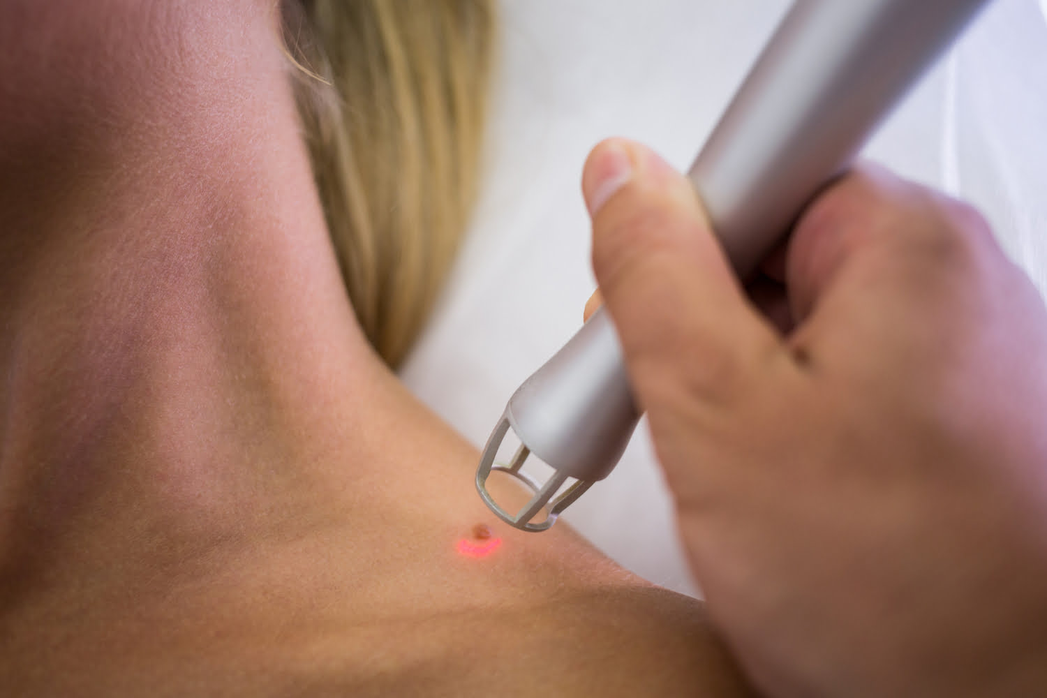 Medical professional carefully removing a mole from a woman's shoulder as part of dermatological treatment.