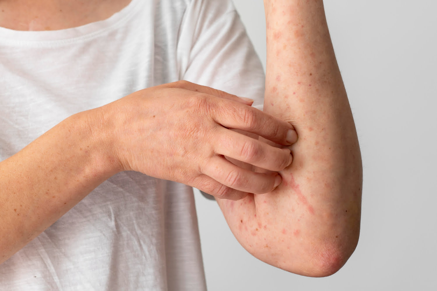 Redness and swelling on a person’s arm caused by an allergic skin reaction.